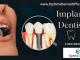 Trusted Implant Dentist in Bristol Delivering Confident Smiles with Precision