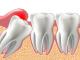 Gentle & Professional Wisdom Tooth Extraction