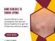 Safe Home Remedies to Shrink Lipoma Without Surgery