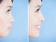 Everything You Need to Know About Chin Implants