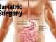 San Francisco Bariatric Surgery Procedures 