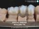 Restore Your Smile with Dental Bridges in Allen, TX – All Smiles Dentistry