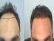 The Ultimate Guide to Hair Transplant in Dubai: Cost, Procedure, and Benefits