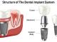A to Z Dental – The Best Place to Get Dental Implants in Richton Park, IL