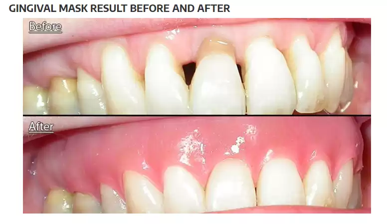 Enhance Smile Harmony with Custom Gingival Mask  Solutions