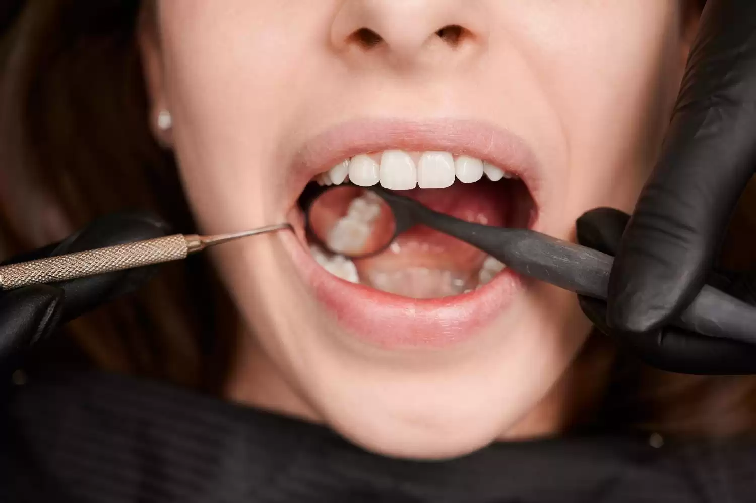 Get Tooth-Colored Fillings for a Perfect Smile in the USA