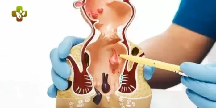 Experienced Doctors for Fissure Treatment in Delhi