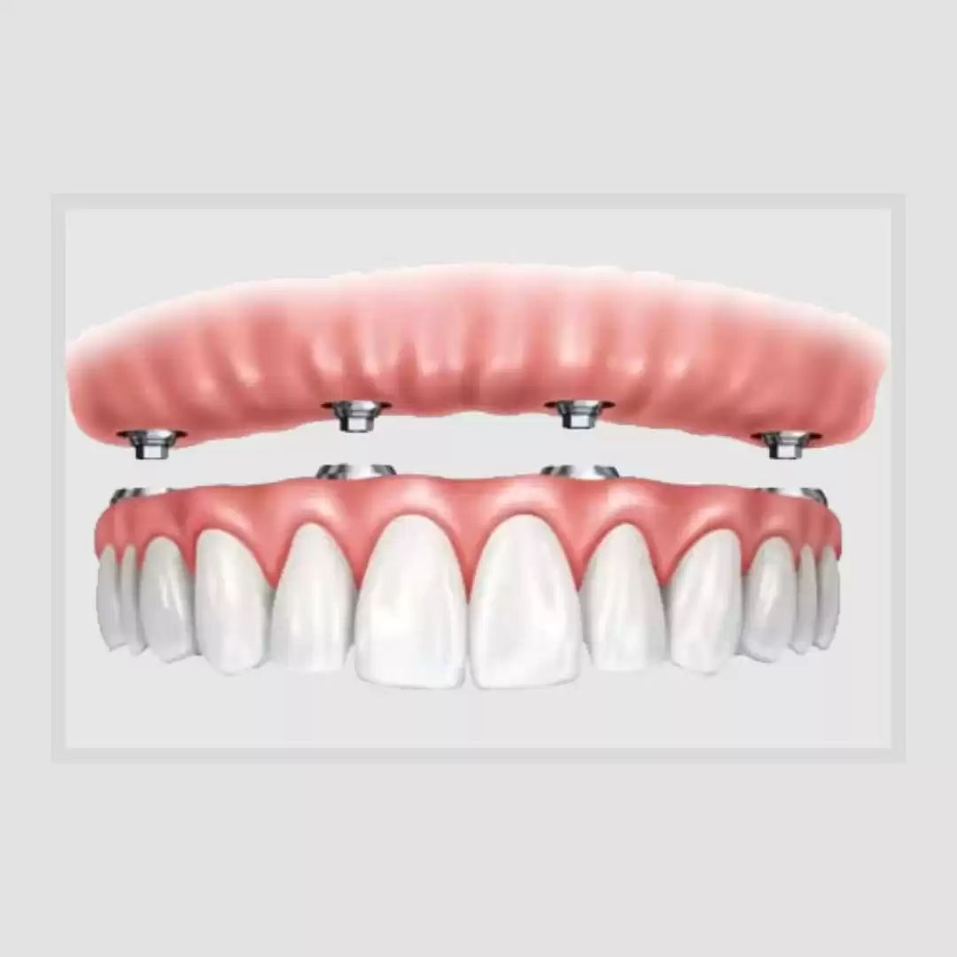 Full Arch Dental Implant Kenner Complete Guide & Benefits