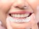 Affordable Braces Singapore – Straighten Your Smile with Expert Care