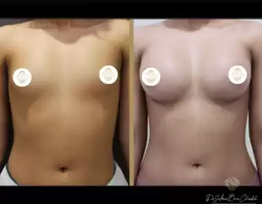 Breast Augmentation in Abu Dhabi & Dubai - Dr. Salma Cheikh