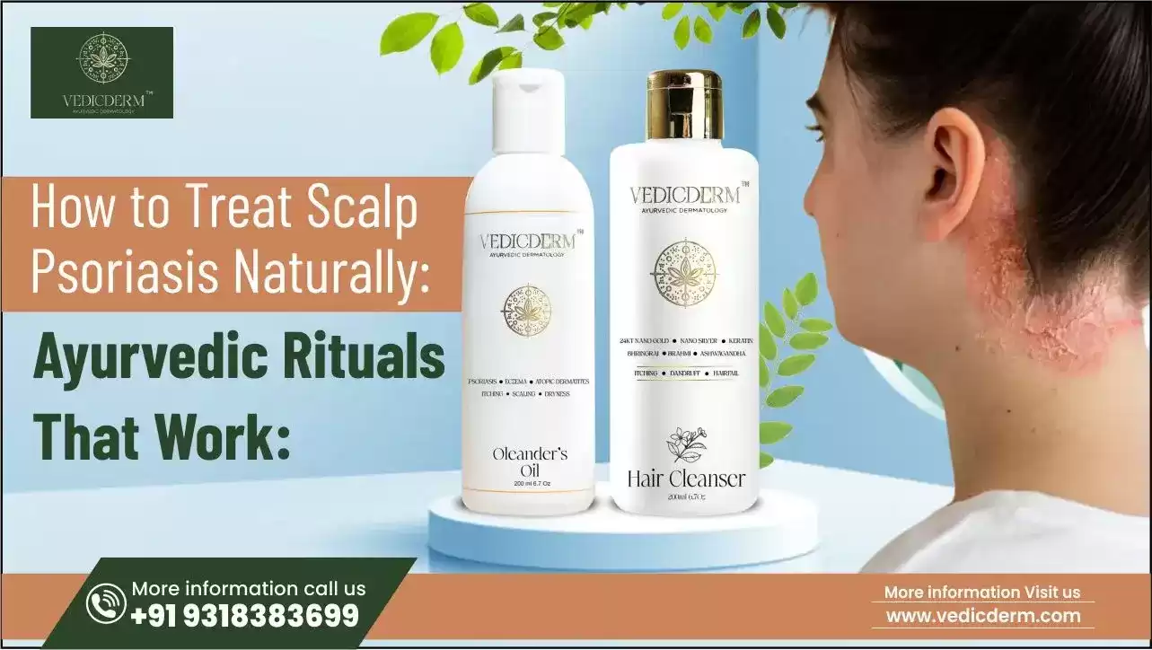 How to Treat Scalp Psoriasis Naturally: Ayurvedic Rituals That Truly Work | Best skincare brand in India