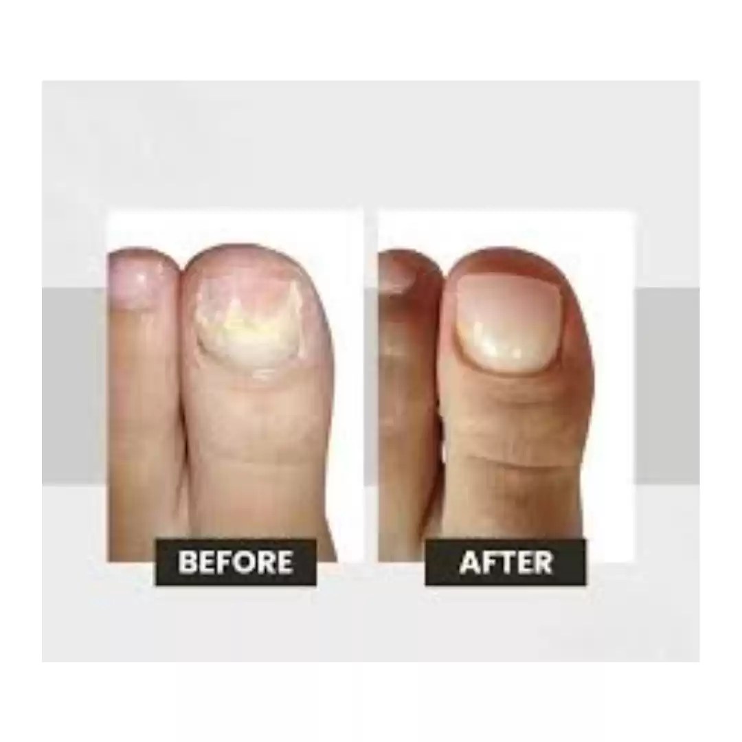KeryFlex Nail Restoration in Houston for Healthy Looking Nails