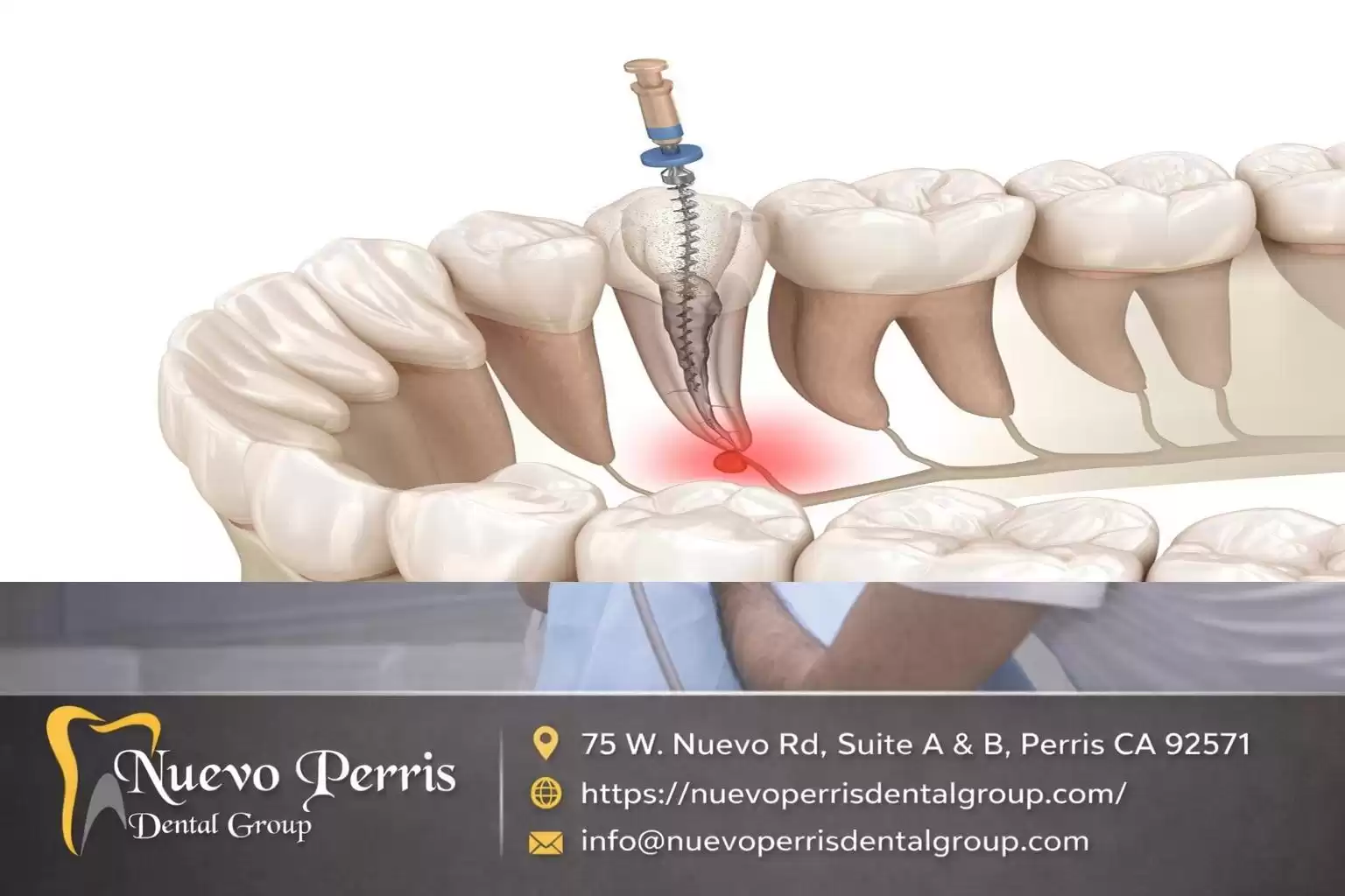 Top-Rated Root Canal Treatment in Menifee – Gentle Dentistry