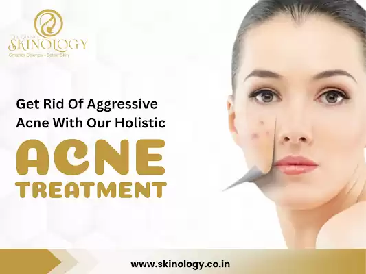 Acne & Rosacea Treatment in Indore for Clear Skin