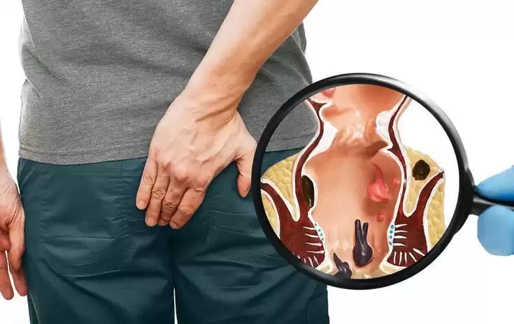 Advanced Ksharsutra Treatment for Fistula with Lasting Relief