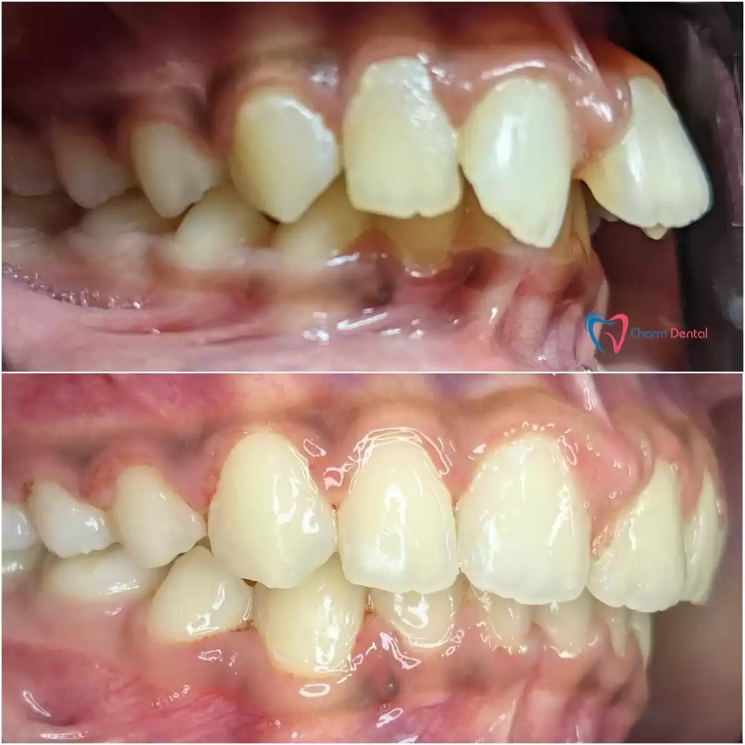 Get a Flawless Smile with Custom Porcelain Veneers in Katy, TX