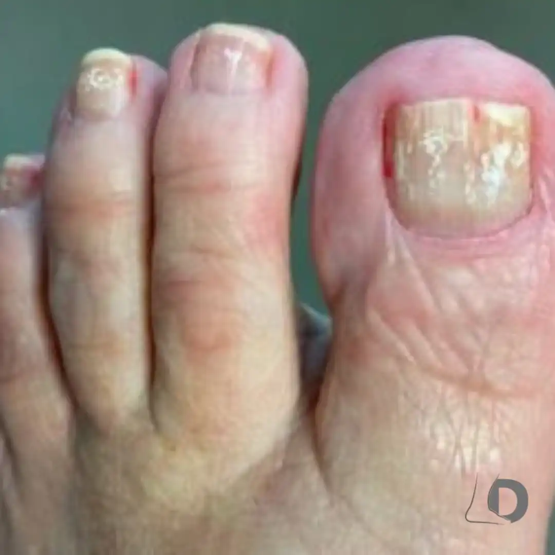 White Marks on Toenails Causes and Treatment Guide