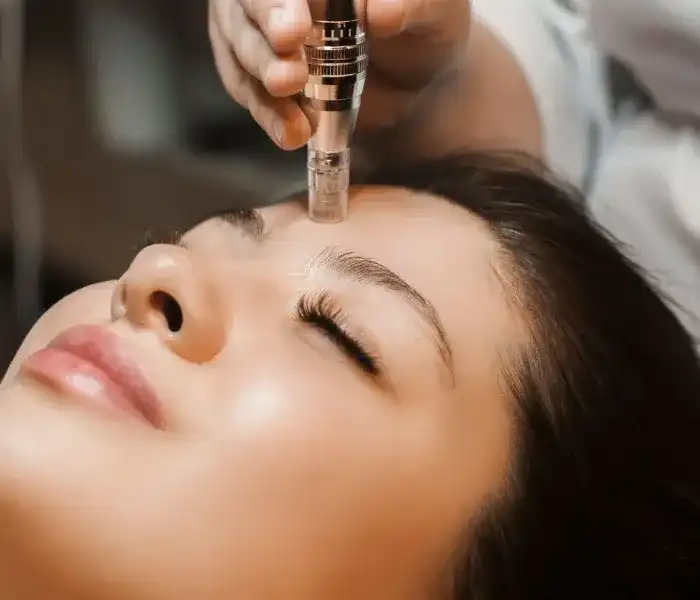 Trusted Microneedling Near Islington London