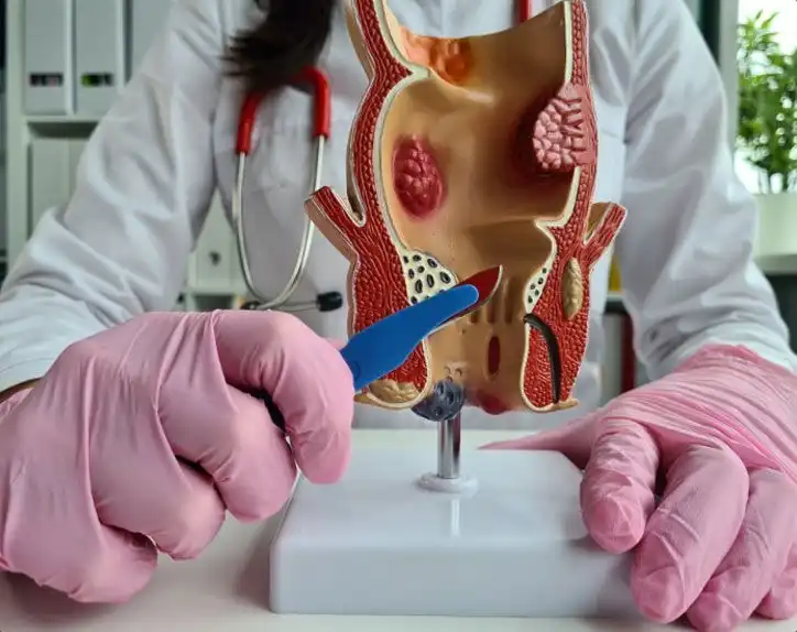 Advanced Care for Fistula and Fissure Problems in Delhi 