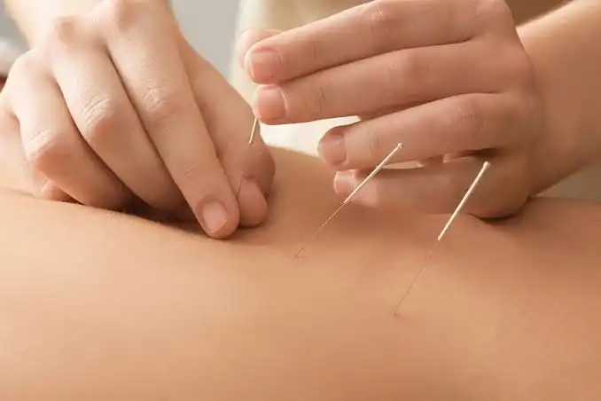 Acupuncture For Sciatica NYC