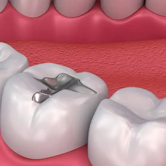 Composite Teeth Filling Abroad | Affordable Dental Care with Meditouring
