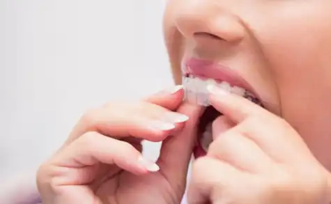 Invisalign Treatment In Woodbridge ON