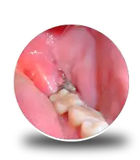 Best Wisdom Tooth Pain Extraction Services