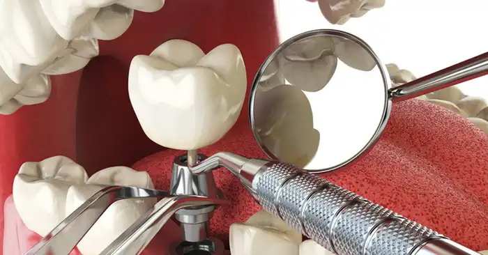 Invisalign for Teeth Alignment Delhi for a Straighter, Healthier Smile – Dental Delhi