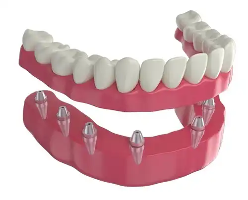 Comfortable Dentures in Bristol PA for a Natural Looking Confident and Healthy Smile
